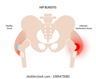 Inflamación de la bursitis trocánica. Bursa inflamada en la cadera humana. Dolor y deformidad en el cuerpo masculino. Afiche anatómico musculoesquelético para clínica u hospital. Ilustración vectorial plana de banderas médicas