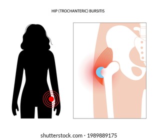 Trochanteric bursitis inflammation. Inflamed bursa in human hip. Pain and deformity in female body. Anatomical musculoskeletal poster for clinic or hospital. Medical banner flat vector illustration