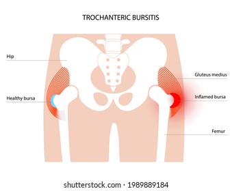 Inflamación de la bursitis trocánica. Bursa inflamada en la cadera humana. Dolor y deformidad en el cuerpo masculino. Afiche anatómico musculoesquelético para clínica u hospital. Ilustración vectorial plana de banderas médicas