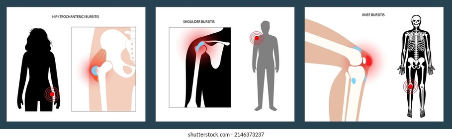 Inflamación por bursitis trocanétrica, schoulder y rodilla. Bursa inflamada en el cuerpo humano. Dolor y deformidad en la silueta masculina. Afiche anatómico musculoesquelético para clínica u hospital