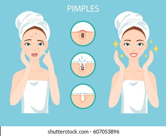 Troubled woman with female facial skin problem needs to care about: infographic of pimples and stages of their treatment and clearance.