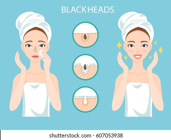 Troubled woman with female facial skin problem needs to care about: infographic of clogged nose pores and blackheads. Stages of treatment and clearing.