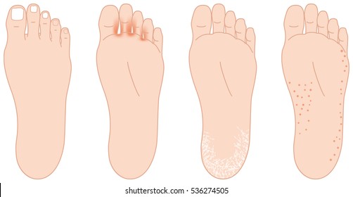 Troubles of the soles of the feet. 