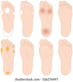 Troubles of the soles of the feet. Athlete's foot etc.