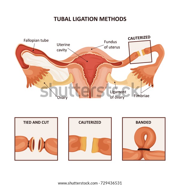 Tubal Ligation Methods Sterilization Options Female Stock Vector Royalty Free 729436531 0599