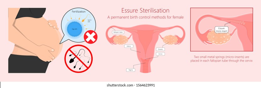 Cirugía de ligadura tubal control de la natalidad permanente bloqueada prevenir corbata ovárica uterina bandadas con cauterización de esterilizaciones bloqueo