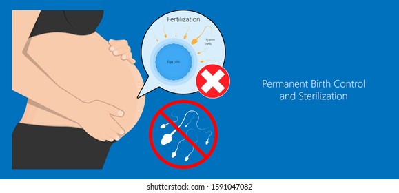 Tubal ligation surgery permanent birth control blocked prevent egg ovary tie uterine banded cauterized sterilizes block