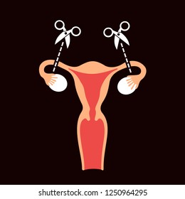 Tubal Ligation And Tubectomy - Reproductive Female And Woman Organ After Sterilization And Sterilisation. Permanent Contraception And Birth Control. Vector Illustration