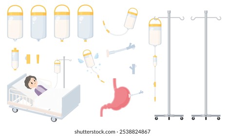 Material de ilustração de alimentação do tubo set_Gastrostomy_NG