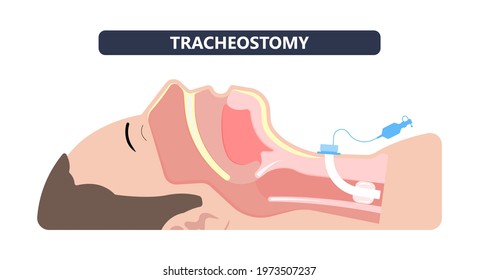 Tube Oxygen Lungs Face Mask Airway Breathing Trachea Neck Machine Medical Surgery ICU Care Unit ARDS Acute Edema Nursing Suction Catheter Injury Stoma Disease Coma Obstructive Sleep Apnea Blocked 19