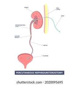 Tube Stent Bag Blocked Kidney Stone Tumor Urine Urinary Drain Renal Ileal Conduit Stoma Foley Bladder Pelvis Obstructive Ureter Shock Wave ESWL Pain Cystitis Remove Surgery Pee Cancer Tract Transplant