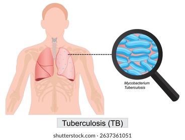 Tuberculosis is a bacterial disease that usually affects the lungs.Tuberculosis, also called TB is a serious illness that mainly affects the lungs.Medical healthcare,vector illustration.