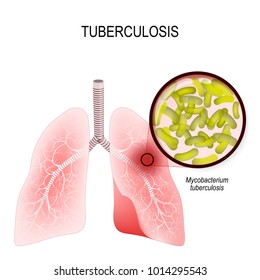 Tuberculosis is an infection caused by bacteria. Lungs of infected person. Mycobacterium tuberculosis close-up