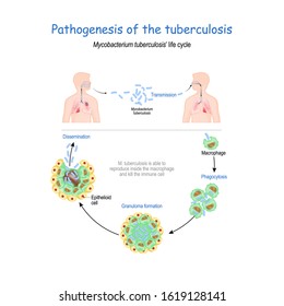 433 Tuberculosis Transmission Images, Stock Photos & Vectors | Shutterstock