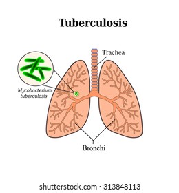 Tuberculosis. Lung disease. Tubercle bacillus. Vector illustration on isolated background.