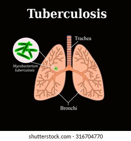 203 Tuberculosis Lesion Images, Stock Photos & Vectors | Shutterstock