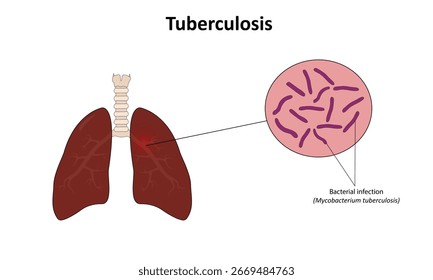  Tuberculosis in the lungs vector illustration