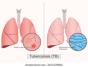 Tuberculose (TB) é uma doença infecciosa potencialmente grave. É causada por bactérias chamadas Mycobacterium tuberculosis e se espalha pelo ar quando uma pessoa infectada tosse, espirra ou canta