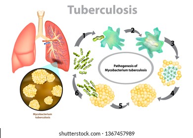 Mycobacterium Tuberculosis Images Stock Photos Vectors