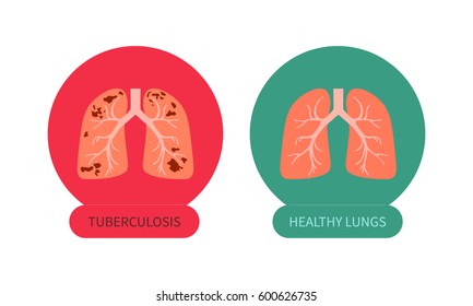 Tuberculosis versus healthy lungs symbol. TB awareness sign. Medical solidarity day concept. Anatomy of people. Vector illustration made in cartoon style.