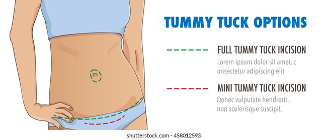Tummy tuck, abdominoplasty infographic banner for web, posters and brochures. Abdominal or liposuction plastic surgery. Closeup of slim female stomach. Vector illustration.