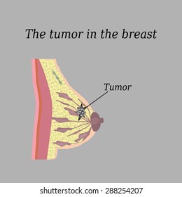 The tumor in the breast. On a gray background. The structure of the breast. Mammary gland.