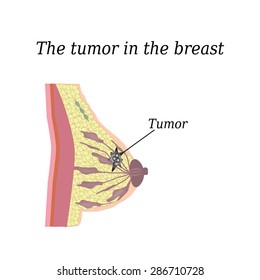 The tumor in the breast. On isolated background. The structure of the breast. Mammary gland