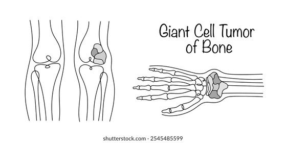 Um tumor constituído por células multinucleadas gigantes e formações unicelulares. Desenhar o tumor de células gigantes do fêmur e do pulso. Ilustração médica sobre o tópico das doenças ósseas. Ilustração vetorial.