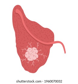 A Tumor On The Parotid Salivary Gland. Medical Vector Illustration.