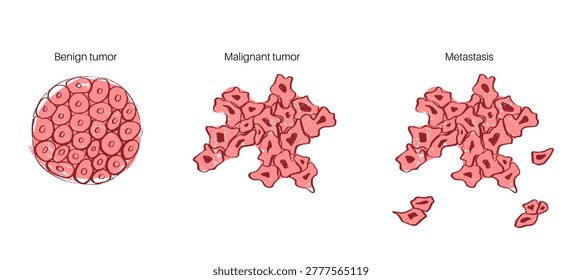 Tumor progression from benign to malignant and metastasis stages. Hand drawn red sketch of encapsulated cells, invasive cancerous growth, and cell spreading. Vector for oncology and cancer research