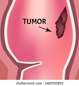 Un tumor en el recto. Estructura del recto del intestino. Tipos de pólipos y tumores en el colon. Infografía. Ilustración vectorial en fondo aislado.