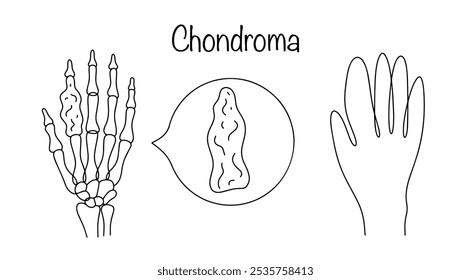 A tumor that is most often localized in the short tubular bones of the hand and foot. Drawing a continuous line of the chondroma of the phalanx of the index finger. Simple vector illustration.