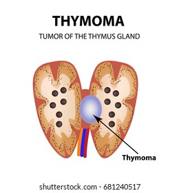 Tumor of the thymus gland. Thymoma. Infographics. Vector illustration on isolated background.