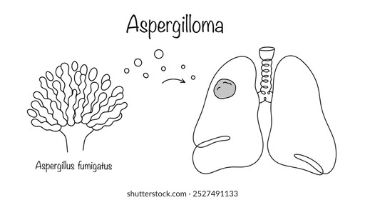 A tumor-like neoplasm of a spherical shape, consisting mainly of mycelium cells of the microscopic mold fungus Aspergillus fume. Fungal spores entered the lungs and formed a disease. Vector.