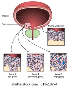 Tumour Bladder Wall Showing Normal Urothelial Stock Vector (Royalty ...