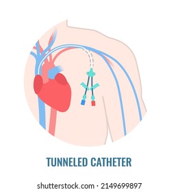 Tunneled Central Venous Catheter Placed In The Subclavian Vein. Man With CVC Long Term Access Device For Chemotherapy Infusions And Blood Sampling. Central Line Tube Close Up. Vector Illustration.