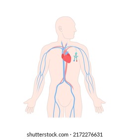 Tunneled Central Venous Catheter Placed In The Subclavian Vein. Man With CVC Long Term Access Device For Chemotherapy Infusions And Blood Sampling. Central Line Tube. Medical Vector Illustration.