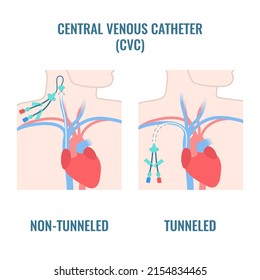 Tunneled and non-tunneled central venous catheters placed in the jugular and subclavian veins. CVC access device placement types. Medical vector illustration.