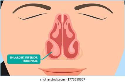 Turbinate hypertrophy ear ENT CPAP nose stop apnea block laser nasal RAVOR RFVTR runny sinus sleep treat airway concha device mucous polyps septal septum throat tissue airflow air way bullosa chronic