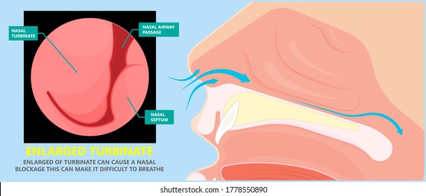 Turbinate hypertrophy ear ENT CPAP nose stop apnea block laser nasal RAVOR RFVTR runny sinus sleep treat airway concha device mucous polyps septal septum throat tissue airflow air way bullosa chronic