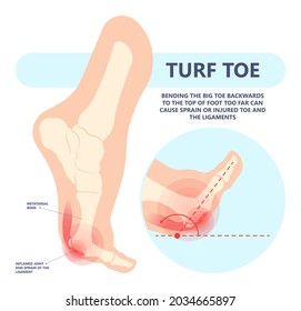 turf toe gout torn tear broken bone big joint sprain sport foot distal pain trauma range of motion bend ankle tendon ball lesser flexor brevis plate bent treat first Aid heal Inflamed deformity stiff