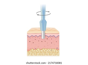 Turn the medical instrument and cut down to the skin layer to get sample tissue. Illustration about Biopsy punches for medical diagnosis and skin cancer treatment.