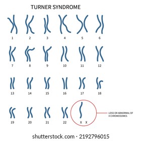 Turner and fragile syndrome of the X chromosomal abnormality test genetic with gonadal dysgenesis disorder in female