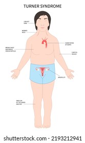 Turner and fragile syndrome of the X chromosomal abnormality test genetic with gonadal dysgenesis disorder in female