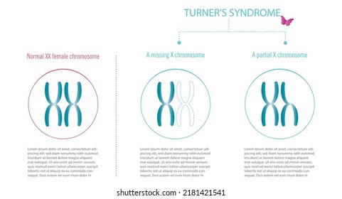 Turner syndrome, representation of XX chromosomes with total or partial lack of X.
Chromosomes in blue tone on white background.space for text.