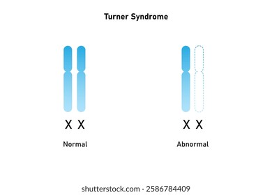 Turner Syndrome Science Design. Vector Illustration.