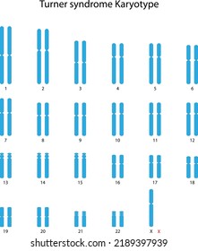 Turner Syndrome (X0) Human Karyotype