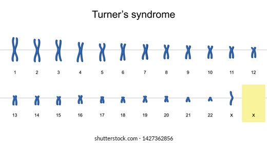 Turner's syndrome karyotype, Nondisjunction of sex chromosomes, Monosomy X