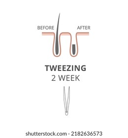 Tweezing body hair removal or epilation method result after two weeks, flat vector illustration. Banner showing tweezing or plucking procedure result.