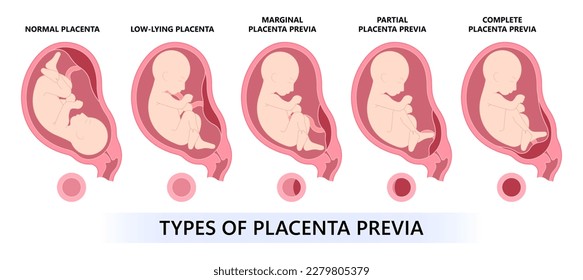 twins baby born defect vasa fetal infant c section nuchal cord fetus vessels funic labor growth low lying birth fluid of test by increta cervix Bilobed sac uterus neck knotted contraction preterm